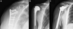 科学网肱骨近端骨折：切开复位内固定术、半肩